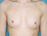 Patient # 39754 Before Photo # 1